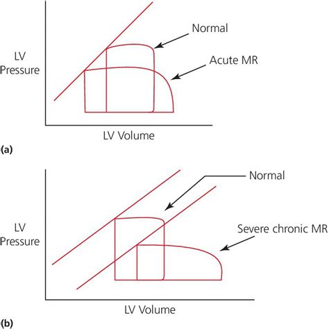 lv pressure volume loop|mitral regurgitation pressure volume loop.